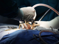 Нижегородские врачи впервые провели операцию по голосовому протезированию 
