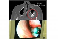 Нижегородский врач извлек зубной имплант из носа пациента 