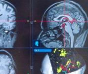 Операцию по предотвращению инсульта впервые провели нижегородские нейрохирурги  