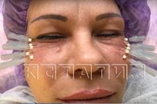 Подпольный косметолог обезобразил лицо молодящейся нижегородки  