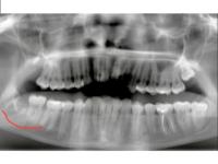 Стоматологи пересадили пациенту собственный зуб в Нижнем Новгороде 