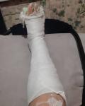 Нижегородка сломала ногу у ворот военного госпиталя 